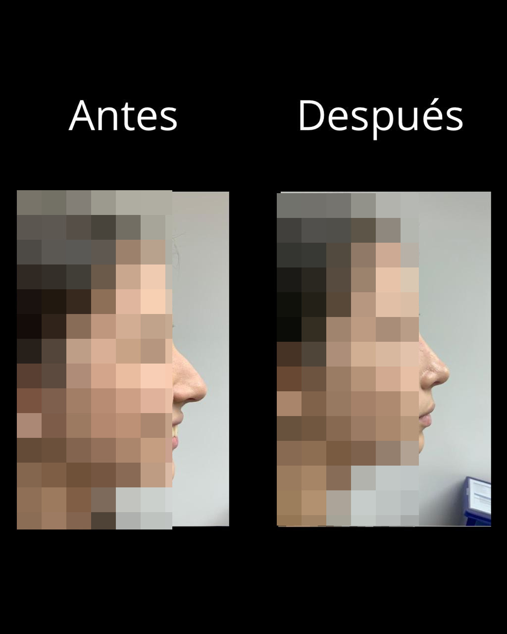 Antes